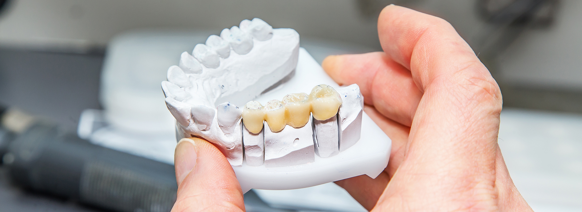 All Kids Dental Care | ZOOM  Whitening, Ceramic Crowns and Dental Bridges